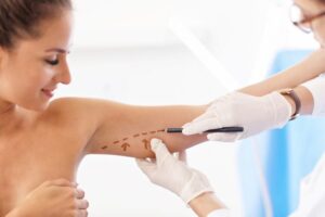 لیفت بازو یا براکیوپلاستی چیست؟ عوارض و فواید