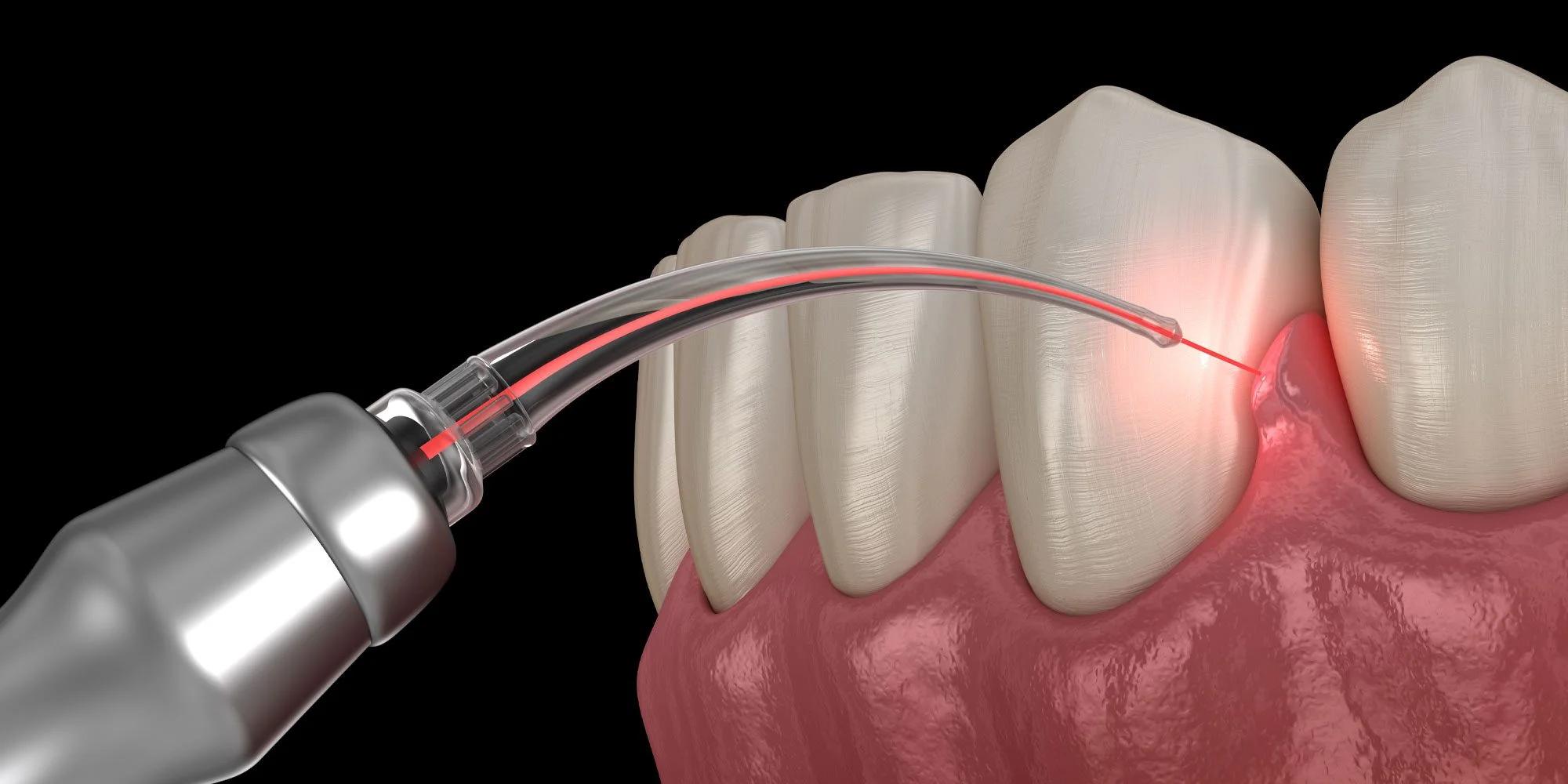 لیزر دندان پزشکی