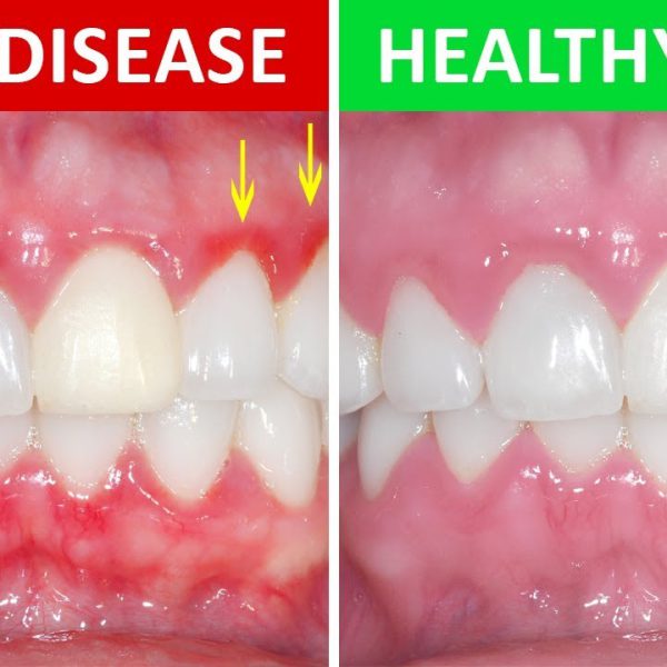 gingivitis-periodontal-disease