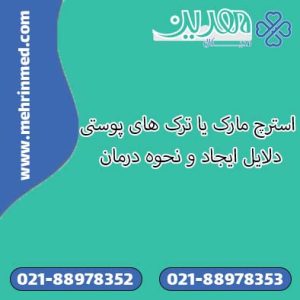 استرچ مارک یا ترک های پوستی، دلایل ایجاد و نحوه درمان