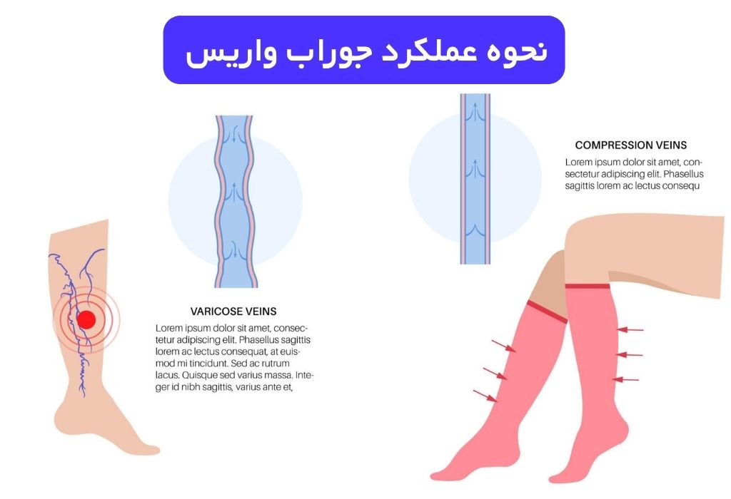 نحوه عملکرد جوراب واریس